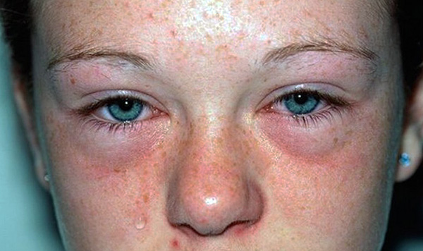 Příznaky alergie na klíšťata mohou být neustálé svědění kůže, kýchání a slzení očí, které se pobytem v domě ještě zhoršují.