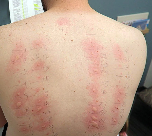 Ovako izgleda rezultat kožnih alergotestova.
