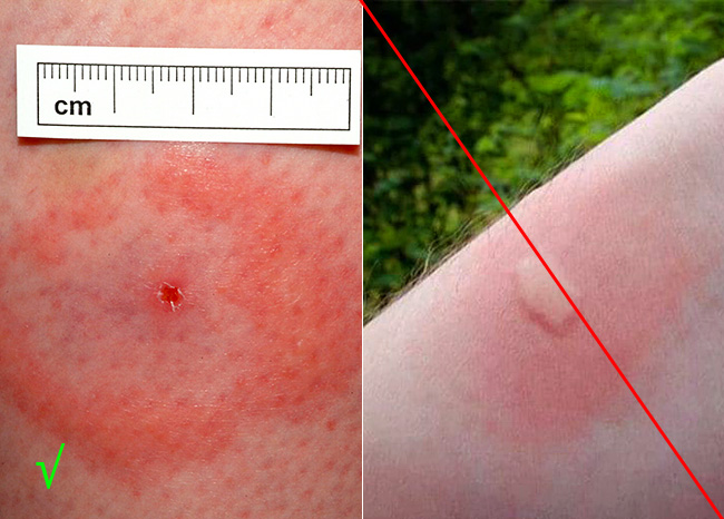 Solda, sağda - bir sivrisinek ısırığından bir kene ısırığı izi var.