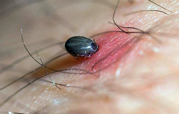 Nếu bạn ấn vào cơ thể của bọ ve cắn, nó sẽ tiết thêm một phần nước bọt vào vết thương.
