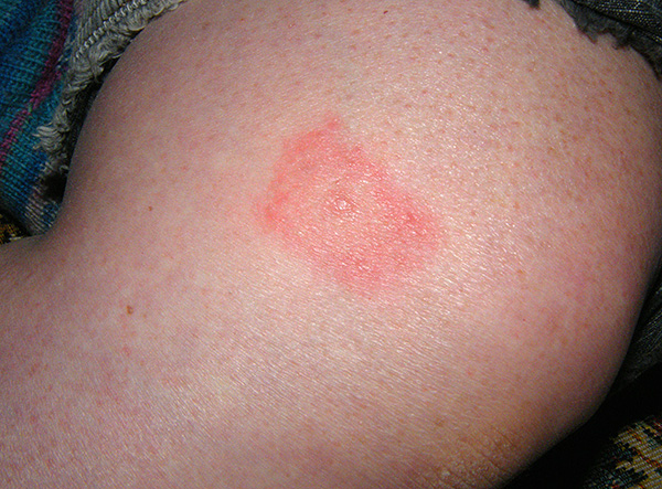 В центъра на ухапването ясно се вижда малка рана - пробиване на кожата.
