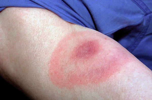 Nó trông giống như ban đỏ hình khuyên di cư - một dấu hiệu của nhiễm trùng Lyme borreliosis.