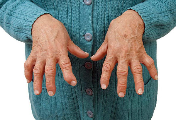 Mga kahihinatnan ng arthritis