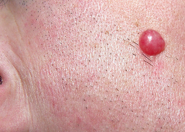 Linfocitoma benigno della pelle - un segno della malattia di Lyme
