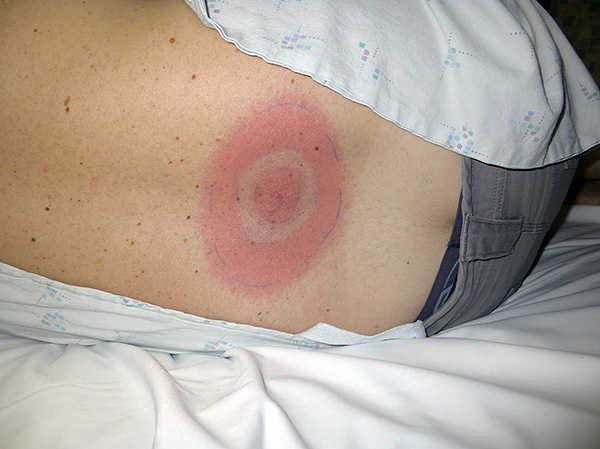 ผื่นแดงวงแหวนเป็นสัญญาณบ่งบอกถึงการติดเชื้อ borreliosis เมื่อถูกเห็บกัด