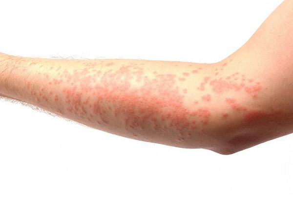 A bőrrel való érintkezéskor allergiás reakció léphet fel, ezért a gyógyszer első alkalmazásakor óvatosan kell eljárni.