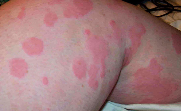 Alergija na ugriz krpelja